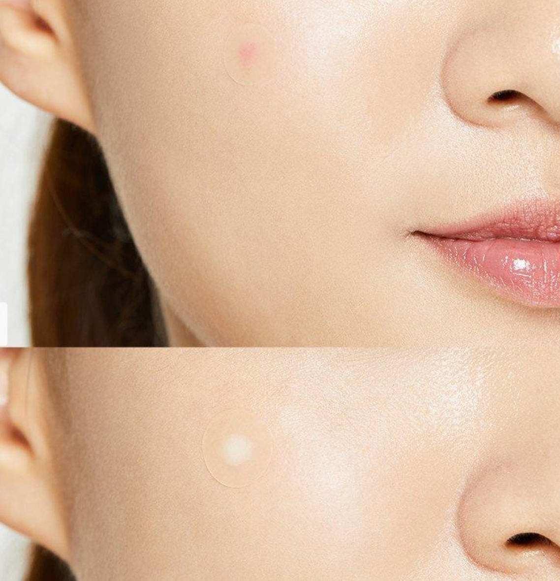 Acne Pimple Master Patch